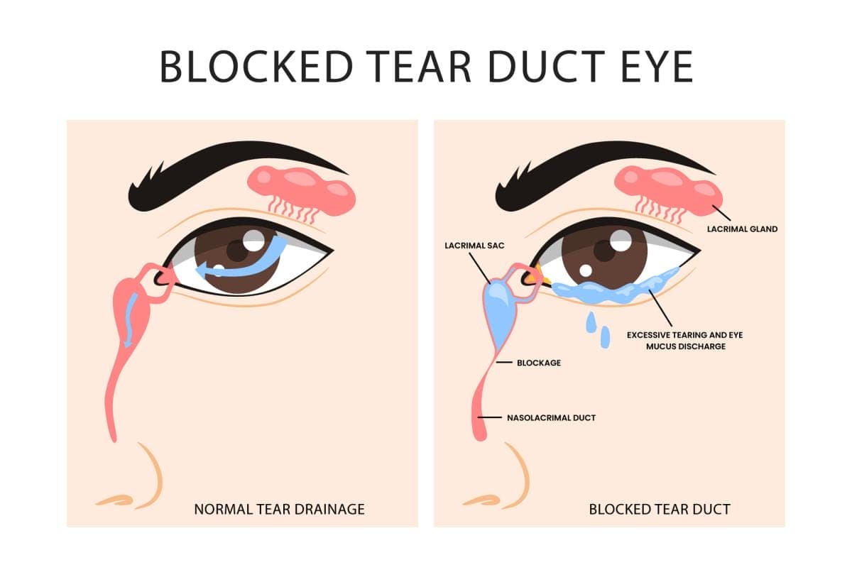 Diagram illustrating normal vs. blocked tear duct.